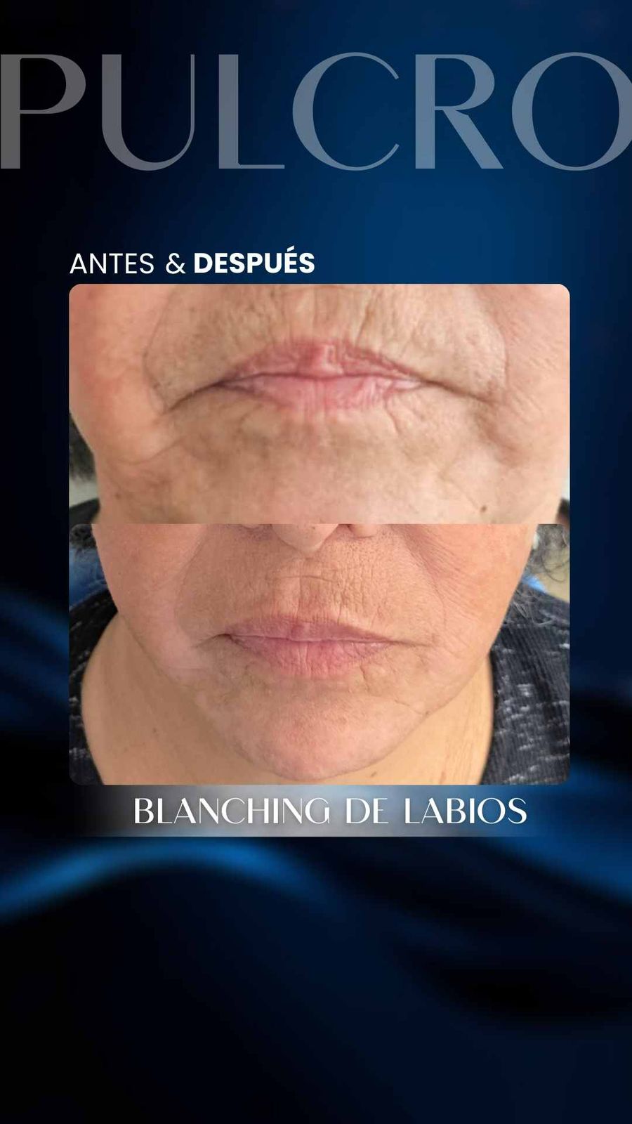 Caso real — Blanching de labios
