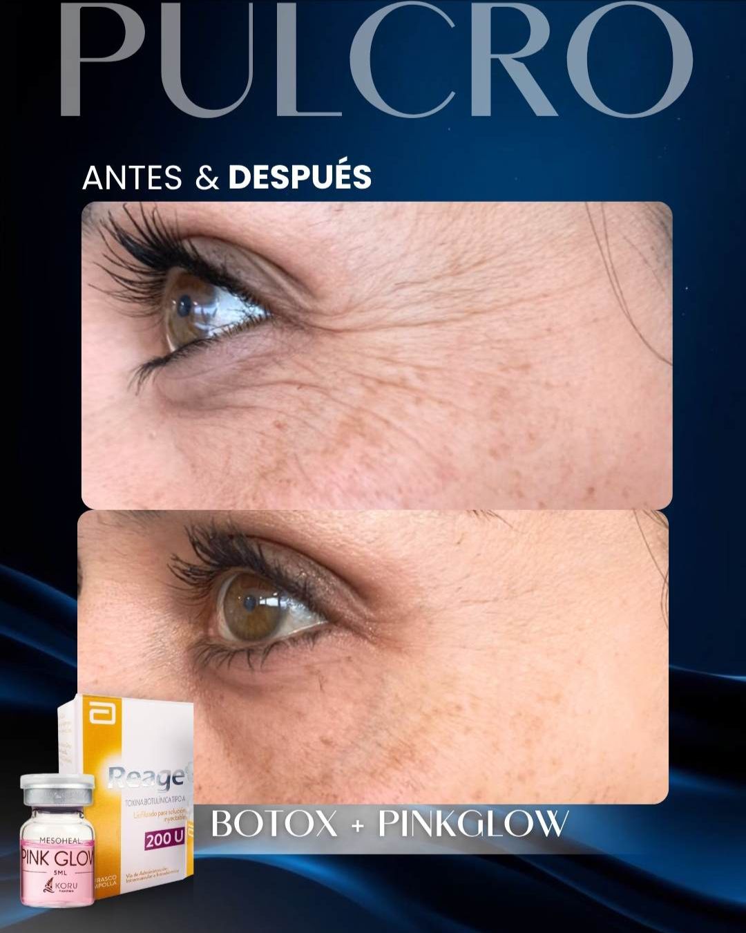 Caso real — Botox + Pinkglow