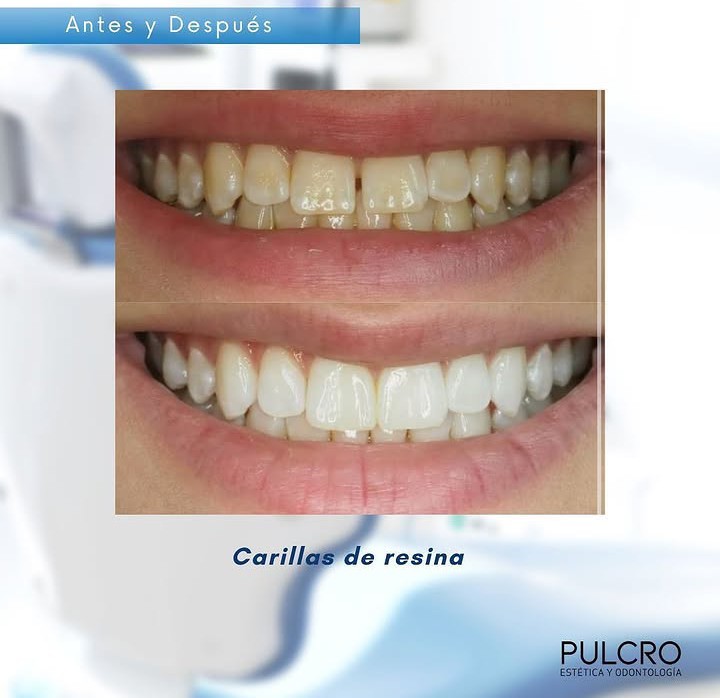 Caso real — Carillas de resina